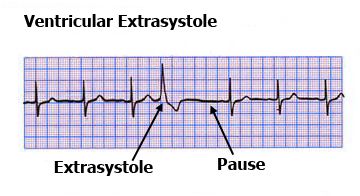 12Ventricular-extrasystole-ECG